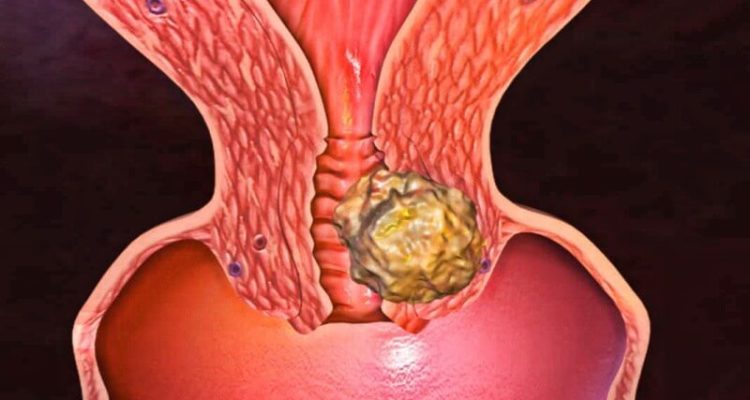 Ранние признаки рака шейки матки: 7 симптомов, о которых должна знать каждая женщина