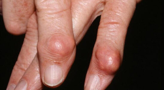 Продукты, вызывающие обострение подагры: что нужно знать каждой женщине