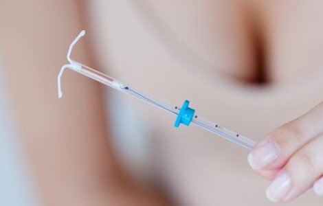 Мирена: кому подходит и когда стоит задуматься о спирали