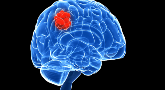 Рак мозга: 6 тревожных симптомов, которые нельзя пропускать