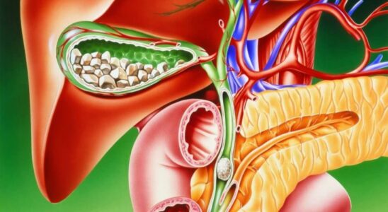 Продукты для профилактики камней в желчном пузыре: что есть, чтобы избежать проблем