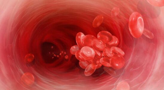 Тревожные симптомы тромбоза: как распознать опасность для ног