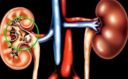 Камни в почках: 6 тревожных симптомов, которые нельзя игнорировать