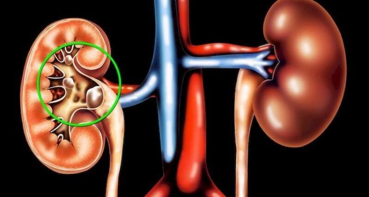 Камни в почках: 6 тревожных симптомов, которые нельзя игнорировать